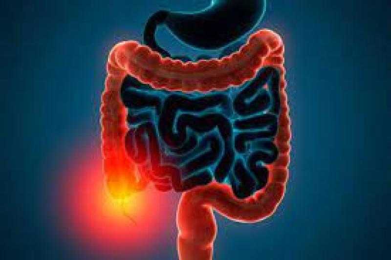 لا تظهر فجأة.. ما هي أعراض التهاب القولون التقرحي؟