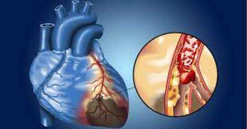 ما هي أعراض انسداد الشرايين.. وكيف تقي نفسك منها؟