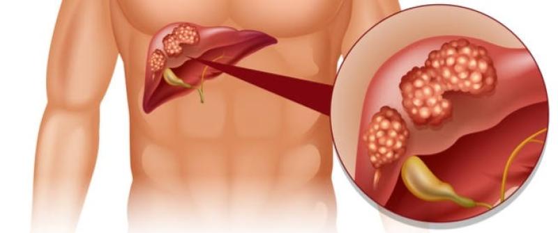 بعد دعم مرضى سرطان الكبد.. كل ما تريد معرفته عن المرض
