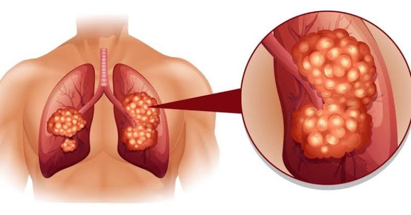 4 خطوات تحميك من الإصابة بسرطان الرئة.. اعرفهم