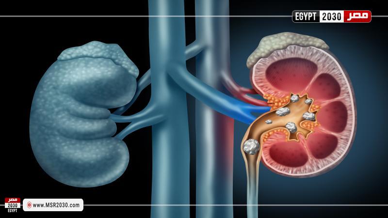 حصوات الكلى