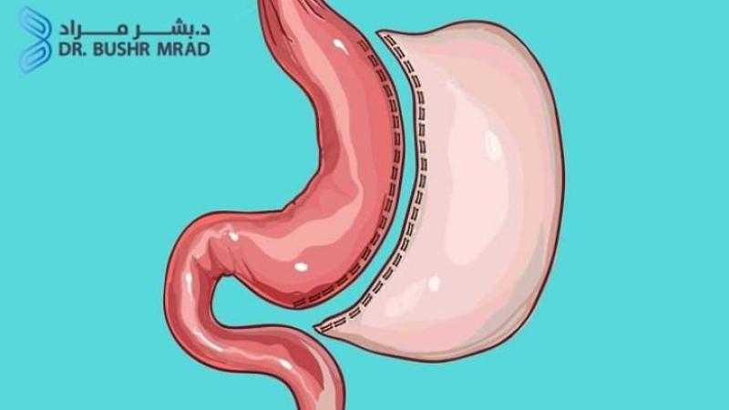 تجربتي مع تكميم المعدة بالمنظار