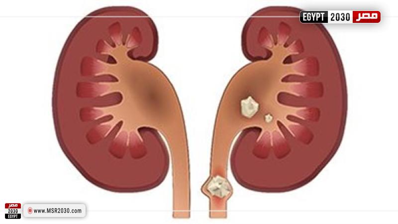 حصوات الكلى 