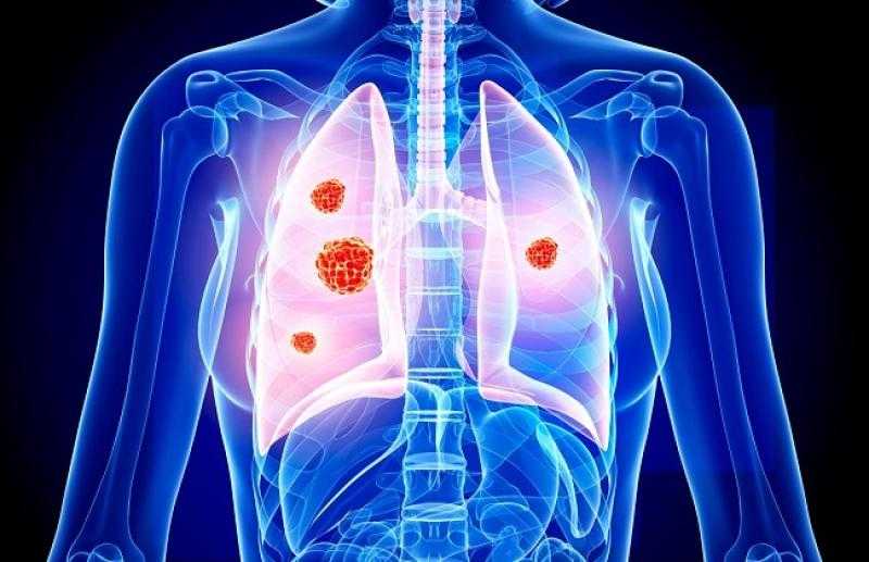 ورم في الوجه والرقبة.. أعراض سرطان الرئة